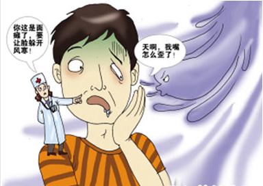 针灸治疗空调吹出的面瘫